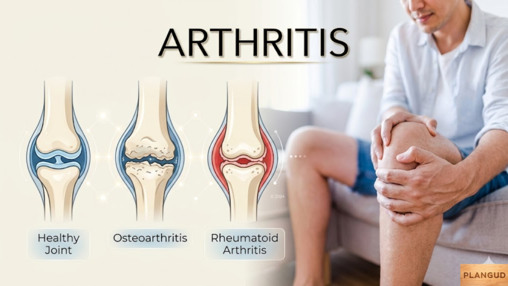 Arthritis